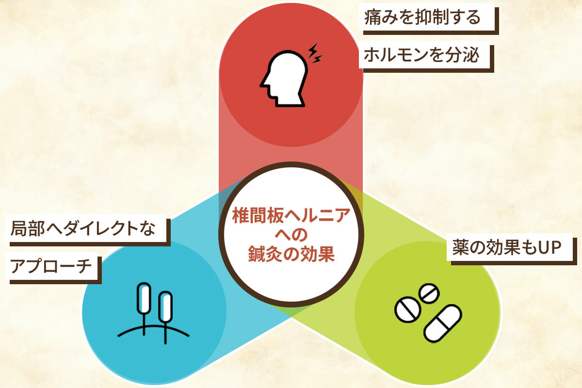 鍼灸が椎間板ヘルニアに効果的な３つの理由