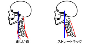 ストレートネックタイプの肩こり